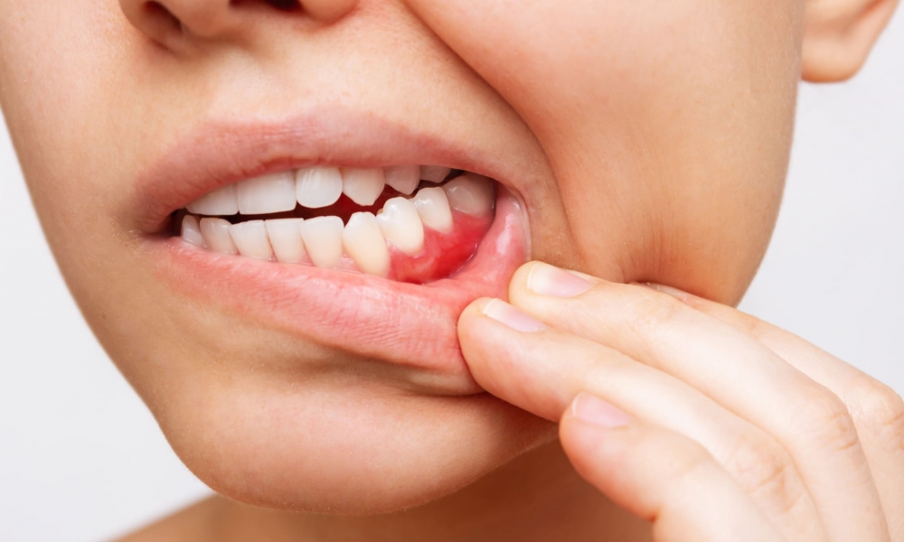 Diş Eti Hastalıkları Sebepleri Nelerdir?