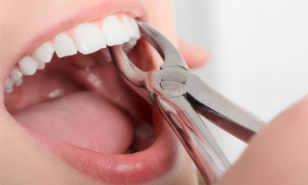 Diş Çekimi Sonrası Ağız Bakımı Nasıl Yapılır ?